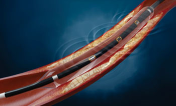 Image: The Lithoplasty balloon catheter system (Photo courtesy of Shockwave Medical).
