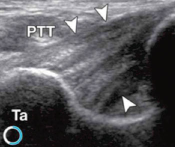 Image: Dynamic High-Resolution US of Ankle and Midfoot Ligaments: Normal Anatomic Structure and Imaging Technique (Photo courtesy of RadioGraphics Journal). Image: Dynamic High-Resolution US of Ankle and Midfoot Ligaments: Normal Anatomic Structure and Imaging Technique (Photo courtesy of RadioGraphics Journal).