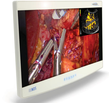 Image: The 27 inch Radiance Ultra (Photo courtesy of  NDS Surgical Imaging).