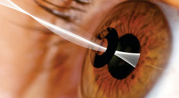 Image: The KAMRA corneal inlay (Photo courtesy of AcuFocus).