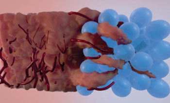 Image: Tissue infiltrates the injectable MAP spheres gel fills, promoting regeneration (Photo courtesy of UCLA).