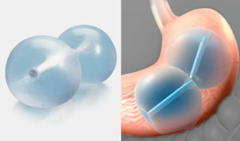 Image: The ReShape Integrated Dual Balloon System (Photo courtesy of ReShape Medical).