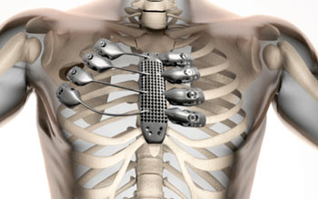 Image: The 3D printed titanium sternum and ribs (Photo courtesy of CSIRO).