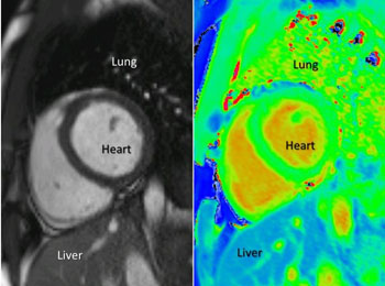 Image: Standard MRI compared to T1-map (Photo courtesy of Dr. Alexander Liu/ OCMR/ University of Oxford). Image: Standard MRI compared to T1-map (Photo courtesy of Dr. Alexander Liu/ OCMR/ University of Oxford).