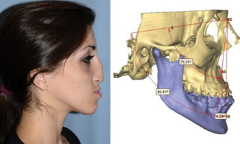 Image: Corrective VSP in a 24-year-old woman with midface deficiency, nasal deformity, and mandibular deviation (Photo courtesy of Plastic and Reconstructive Surgery).