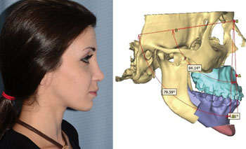 Image: Corrective VSP and surgery aftermath in a 24-year-old woman with midface deficiency, nasal deformity, and mandibular deviation (Photo courtesy of Plastic and Reconstructive Surgery).