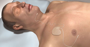 Image: The Inspire Upper Airway Stimulation device (Photo courtesy of Inspire Medical Systems).