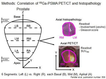 Image: These images compare axial histopathology and axial PET/CT in six segments of the prostate gland of a patient (Photo courtesy of Ludwig-Maximilians-Universitat of Munich). Image: These images compare axial histopathology and axial PET/CT in six segments of the prostate gland of a patient (Photo courtesy of Ludwig-Maximilians-Universitat of Munich).
