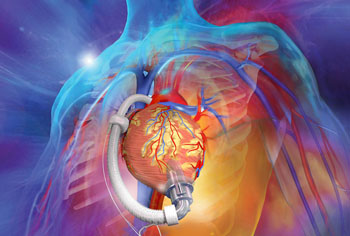 Image: The aVAD intraventricular, axial flow LVAD (Photo courtesy of ReliantHeart).