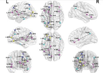 Image: The image shows a pediatric PTSD-related sub-network of the brain (Photo courtesy of RSNA). Image: The image shows a pediatric PTSD-related sub-network of the brain (Photo courtesy of RSNA).