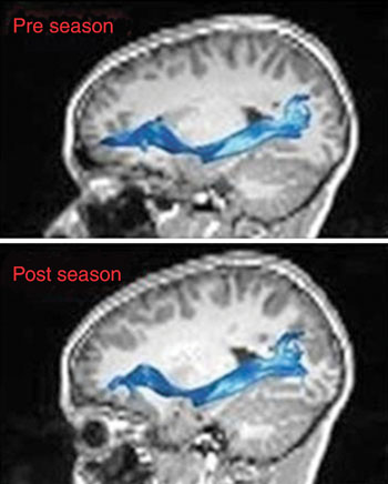 Image: The MR images are of the left inferior fronto-occipital fasciculus before and after the football-playing season (Photo courtesy of RSNA). Image: The MR images are of the left inferior fronto-occipital fasciculus before and after the football-playing season (Photo courtesy of RSNA).