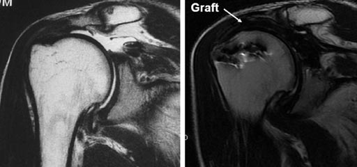 Image: Comparative MRI scans before (L) and four years after ASCR (R) (Photo courtesy of Teruhisa Mihata).