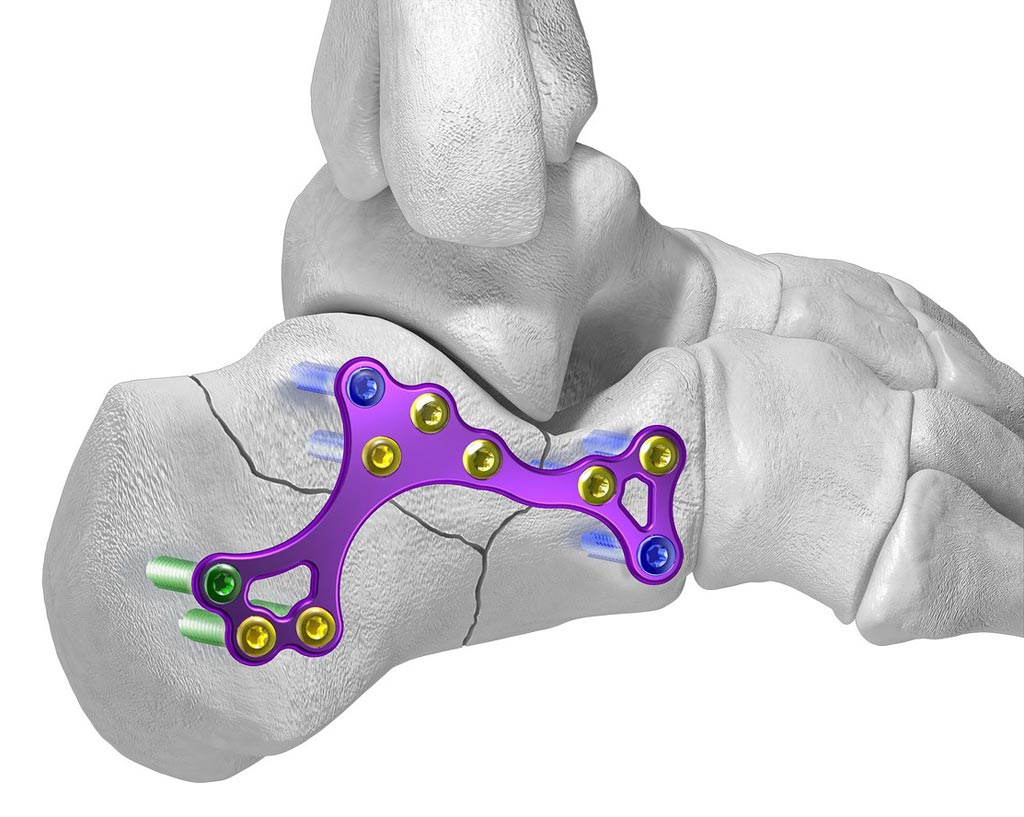 Image: The Sinus Tarsi Support Plate (Photo courtesy of Paragon 28).