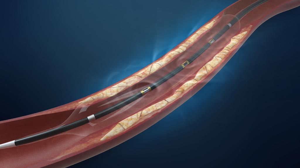 Image: The lithoplasty balloon catheter system (Photo courtesy Shockwave Medical).