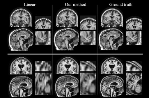 Image: Researchers have devised a new technique to boost the quality of low-resolution MRI scans and make them suitable for use in large-scale studies (Photo courtesy of MIT). Image: Researchers have devised a new technique to boost the quality of low-resolution MRI scans and make them suitable for use in large-scale studies (Photo courtesy of MIT).