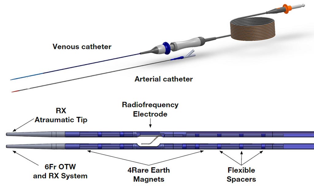 Image: A new two-catheter system creates a non-traumatic AVF (Photo courtesy of TVA Medical).