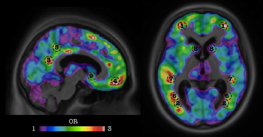 Image: Scientists used AI techniques and big data to develop an algorithm capable of recognizing the signatures of dementia two years before its onset, using a single amyloid PET scan of the brain (Photo courtesy of McGill University).