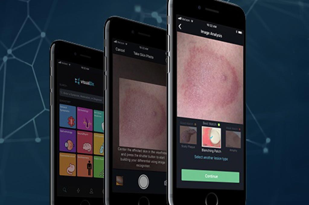 Image: The enhanced VisualDx app with Core ML is a framework enabling on-device machine learning to help provide healthcare professionals with quick and accurate identification of rashes and skin lesions (Photo courtesy of VisualDx).