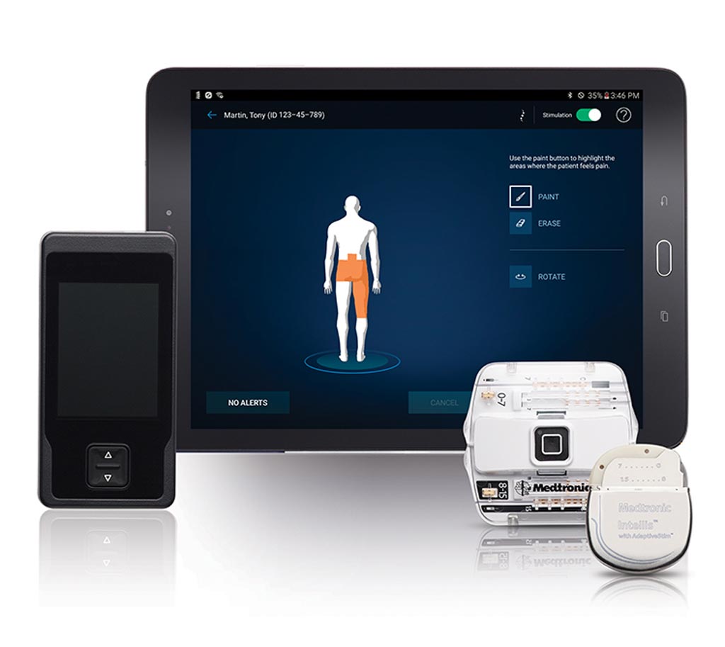 Image: A miniaturized SCS system helps relieve chronic pain (Photo courtesy of Medtronic).