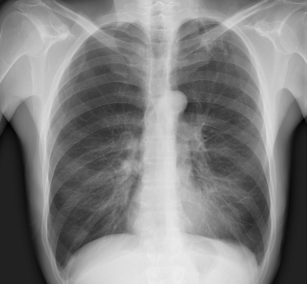 Image: The algorithm CheXNet can diagnose up to 14 types of medical conditions, including pneumonia (Photo courtesy of Stanford ML Group). Image: The algorithm CheXNet can diagnose up to 14 types of medical conditions, including pneumonia (Photo courtesy of Stanford ML Group).