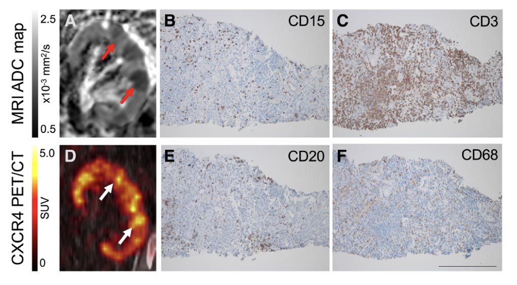 Image: An MRI showing focal restriction of diffusion (A), with corresponding upregulated CXCR4 expression (Photo courtesy of Hannover Medical School). Image: An MRI showing focal restriction of diffusion (A), with corresponding upregulated CXCR4 expression (Photo courtesy of Hannover Medical School).