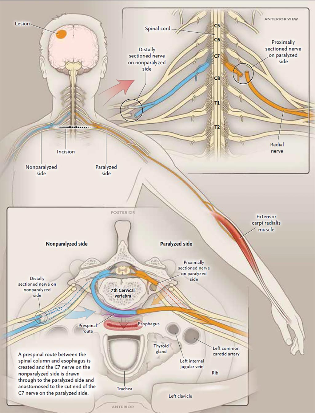 Image: The C7 cervical nerve transfer procedure (Photo courtesy of MX Zheng / Fudan University).