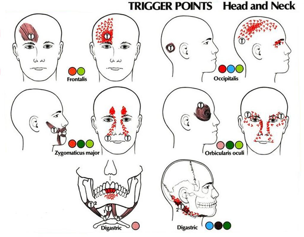 Image: The major migraine trigger points (Photo courtesy of Pinterest).