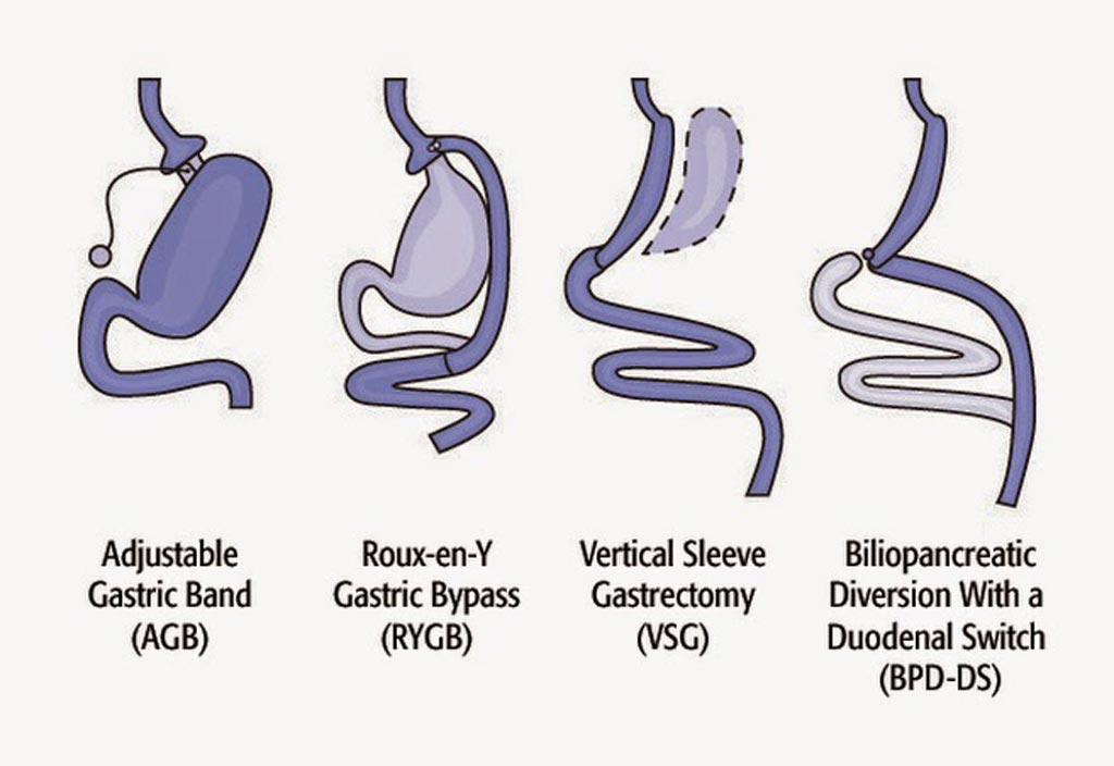 Image: The four common types of bariatric surgery (Photo courtesy of the NIH).