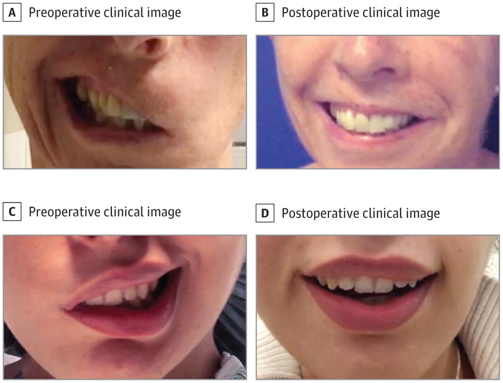 Image: A multivectorial muscle transplant can restore smiles (Photo courtesy of Kofi Boahene / JHU-SOM).