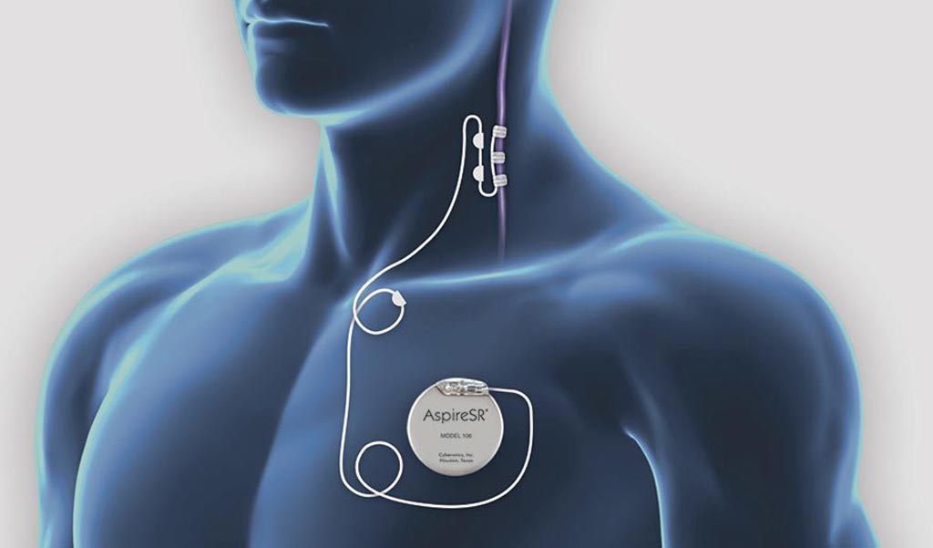 Image: A new study asserts vagus nerve stimulation can speed up stroke recovery (Photo courtesy of LivaNova).