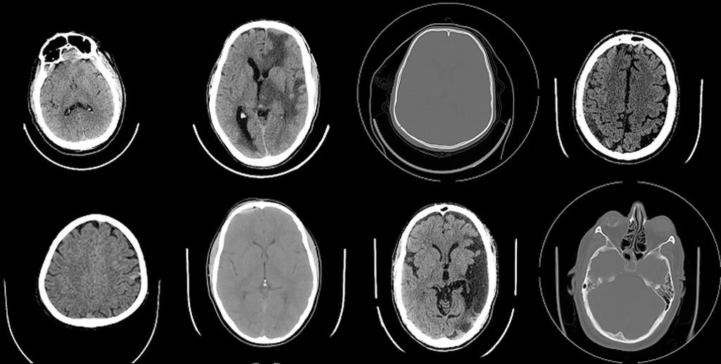 Image: The new AI-powered technology can accurately identify bleeds, fractures and other critical abnormalities in head CT scans and generate reports (Photo courtesy of Qure.ai).