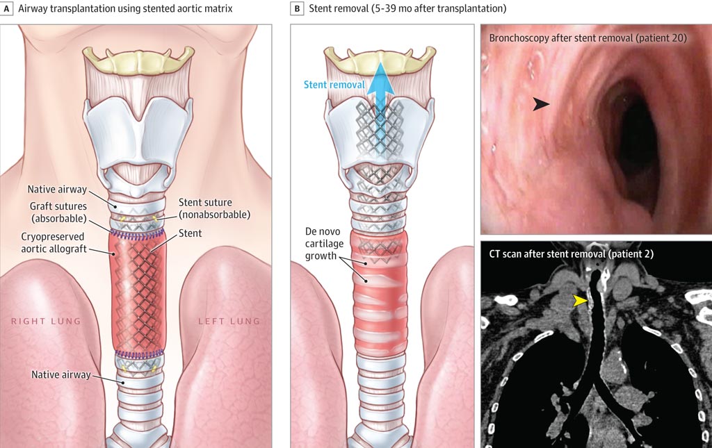 Image: Aortas from deceased donors can be used to reconstruct the trachea (Photo courtesy of JAMA).