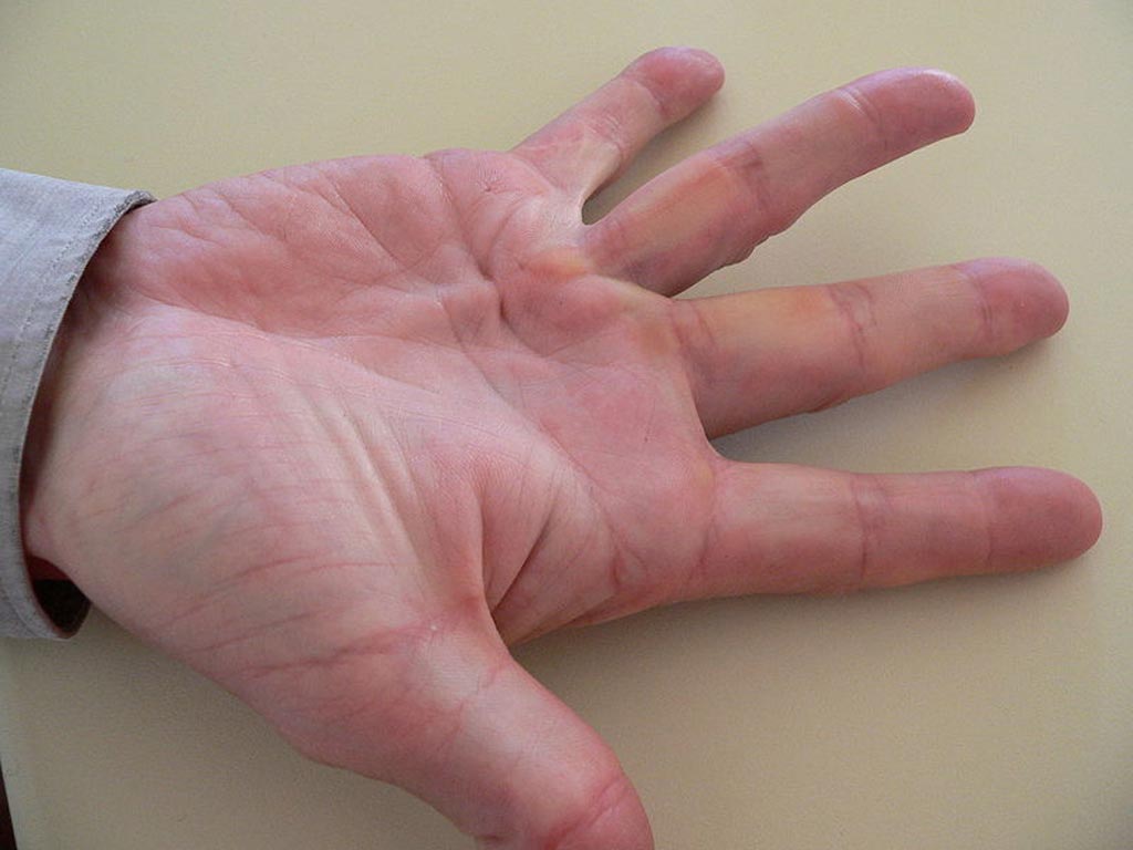 Image: An example of Dupuytren\'s contracture on the ring finger (Photo courtesy of Wikipedia).