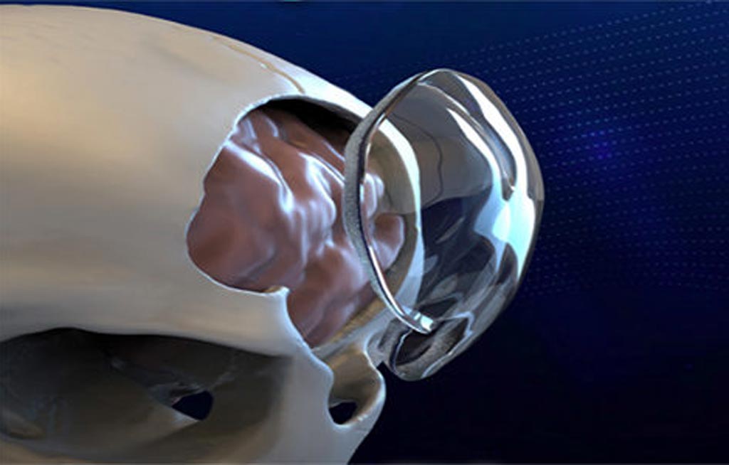 Image: A clear PMMA implant reconstructs the skull following a craniotomy (Photo courtesy of Longeviti).