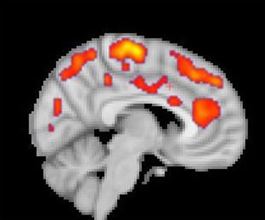 Image: PET image highlights increased glial activation in FM patients with fibromyalgia (Photo courtesy of Marco Loggia/ MGH).