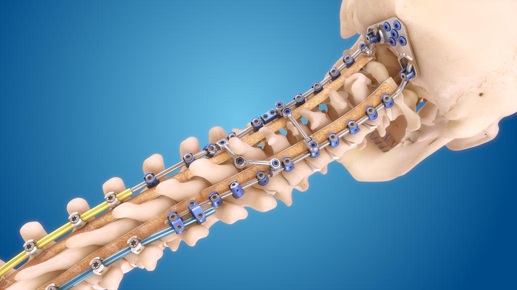 Image: The Infinity Occipitocervical-Upper Thoracic (OCT) system (Photo courtesy of Medtronic).
