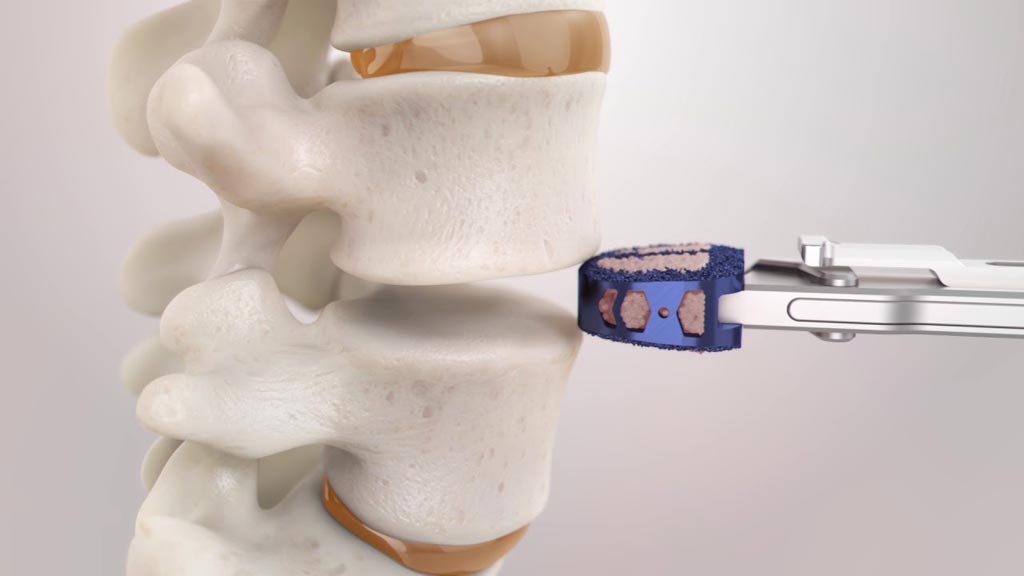 Image: The ENZA-A Titanium ALIF system (Photo courtesy of Camber Spine Technologies).