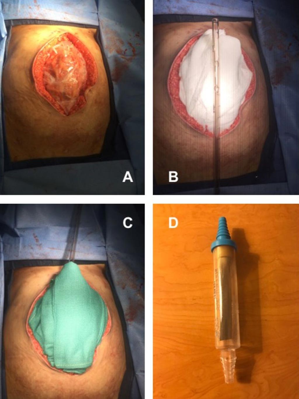 Image: Temporary abdominal closure using NPWT provides a solution for damage control in austere settings (Photo courtesy of Edwin Faulconer/ Derriford Hospital).