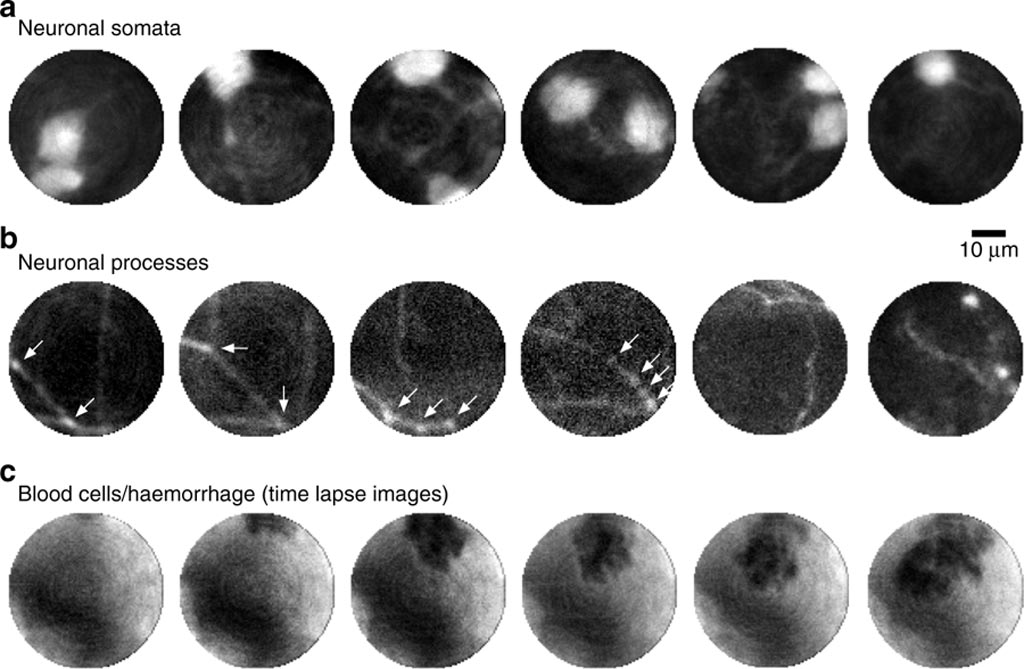 Image: Neuronal somata, neuronal processes, and time-lapse images of a hemorrhage in the primary visual cortex (Photo courtesy of IPTH). Image: Neuronal somata, neuronal processes, and time-lapse images of a hemorrhage in the primary visual cortex (Photo courtesy of IPTH).