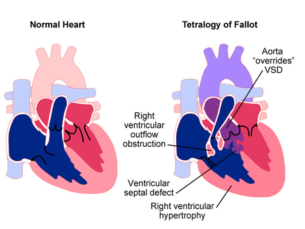 Image: A new study shows Tetralogy of Fallot (TOF) repair has good long-term results (Photo courtesy of MedMovie).