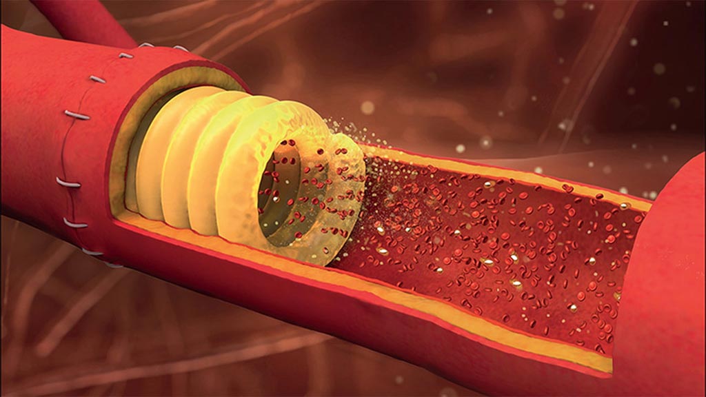 Image: A spiral-shaped printed stent helps surgeons stich arteries back together (Photo courtesy of UNL).