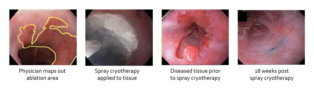 Image: Liquid nitrogen can flash-freeze diseased esophageal tissue (Photo courtesy of CSA Medical).