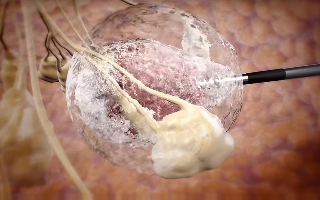 Image: A tumor “IceBall” created during cryoablation treatment (Photo courtesy of IceCure Medical).