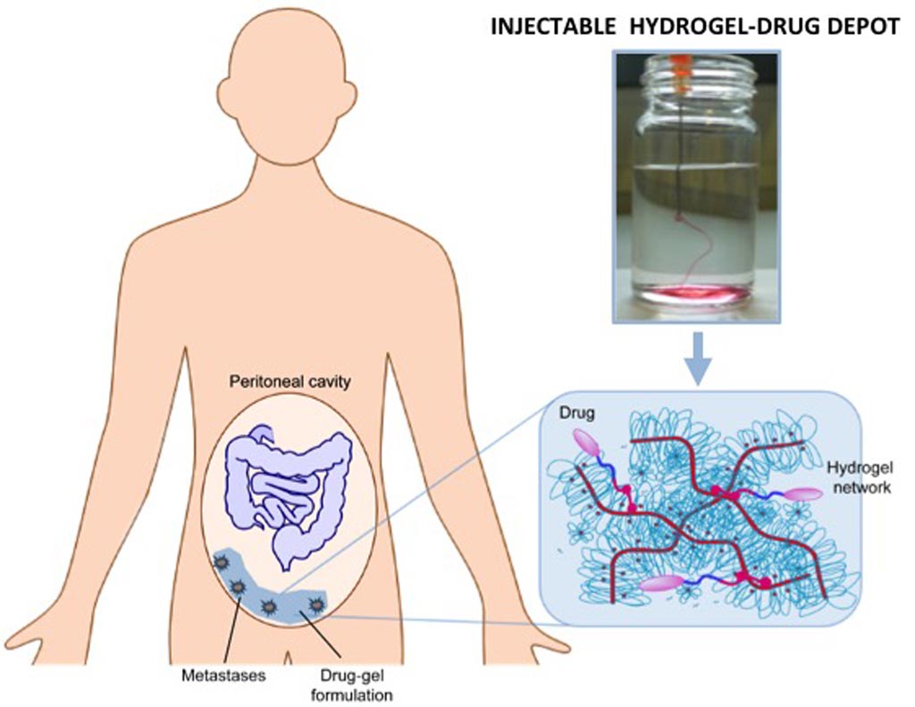 Image: An injectable ‘chemo gel’ could replace abdominal flushes (Photo courtesy of TU/e).