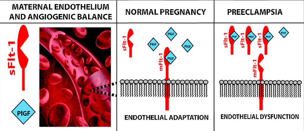 Image: The role of sFlt-1 in maternal preeclampsia (Photo courtesy of Vassilis Tsatsaris).