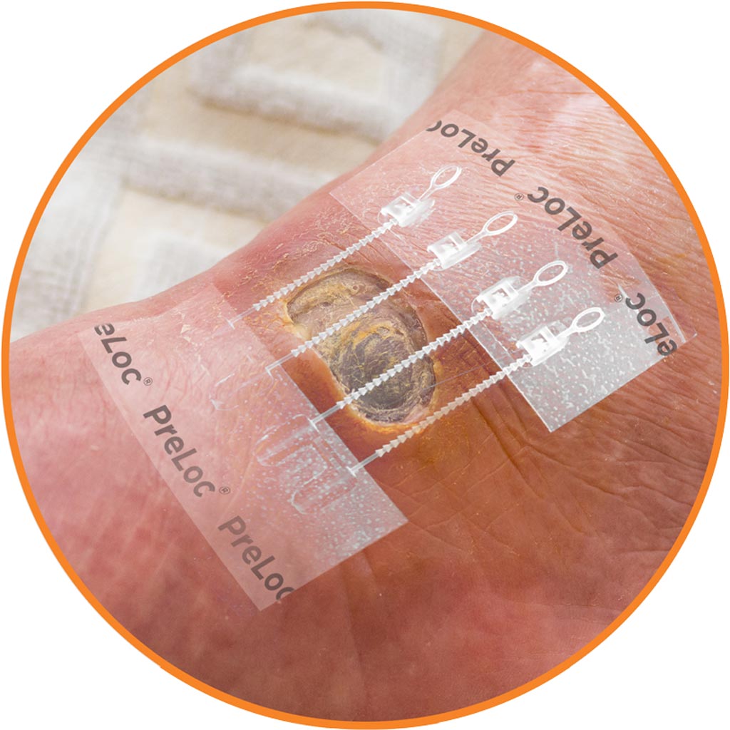 Image: The Preloc monofilament base before wound closure (Photo courtesy of Zipline Medical).