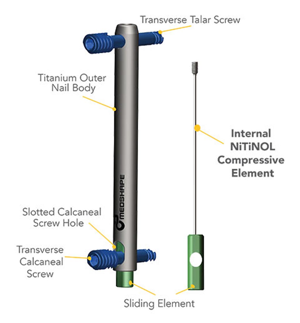 Image: The DynaNail Mini Fusion System assembly (Photo courtesy of MedShape).