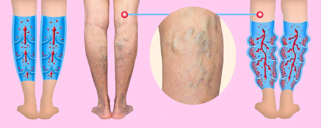 Image: A new study claims that surgery offers the best option for treating varicose veins (Photo courtesy of 123RF).