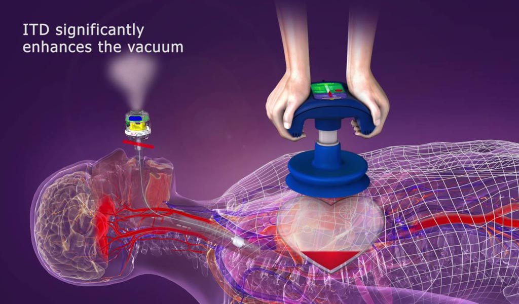 Image: The ResQCPR ITD device (Photo courtesy of ZOLL).