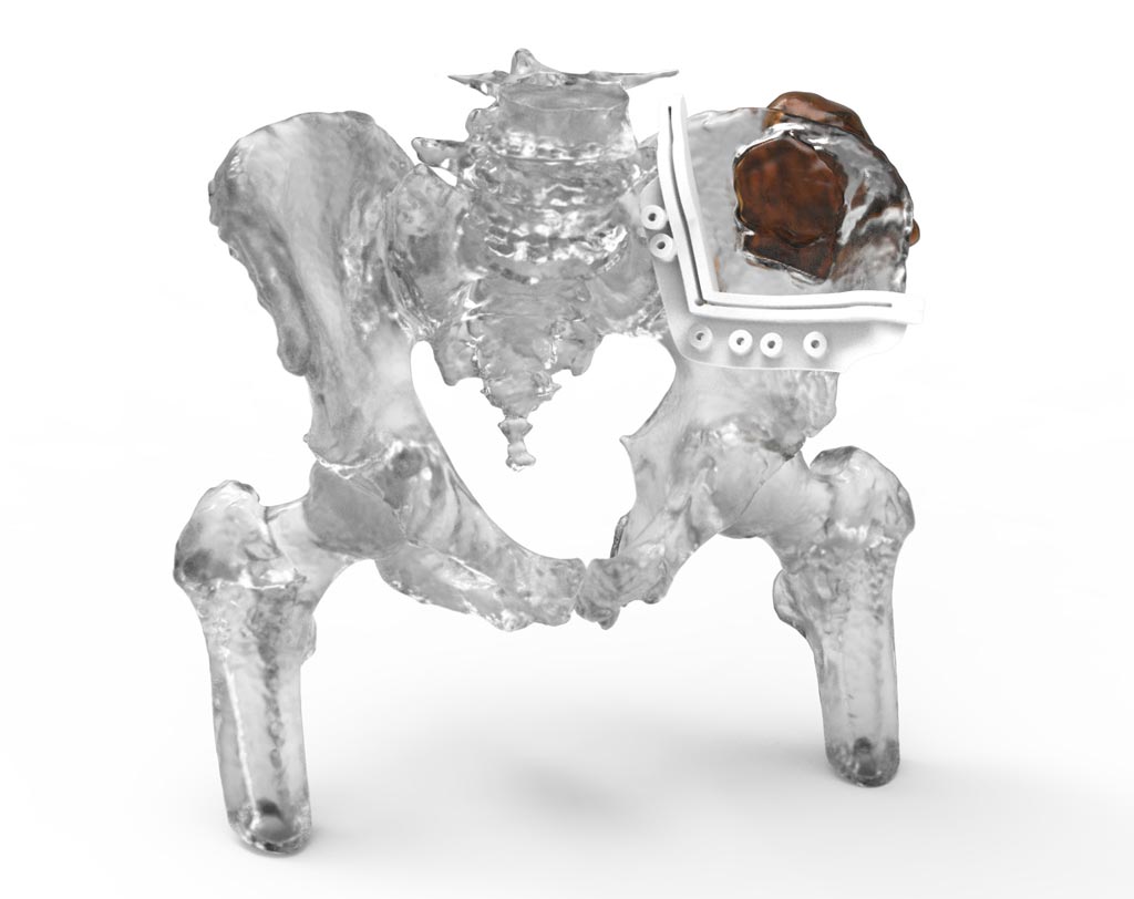 Image: Novel 3D software can help plan bone tumor resections (Photo courtesy of 3D Systems).